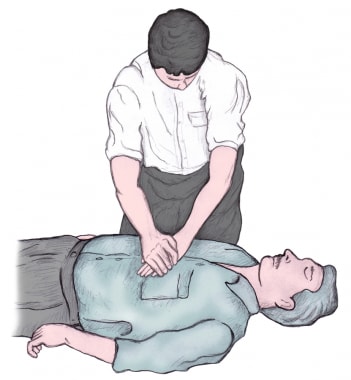 Cardiopulmonary Resuscitation (CPR): Practice Essentials