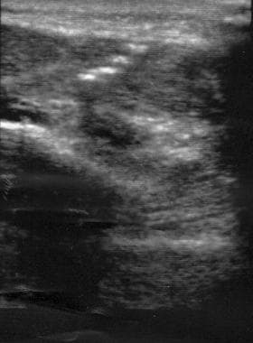 Ultrasound of projectile foreign body fragments in