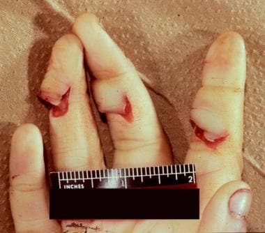 Defensive wounds of the hand/fingers. 