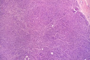 Myoepithelioma Pathology Definition Epidemiology Etiology