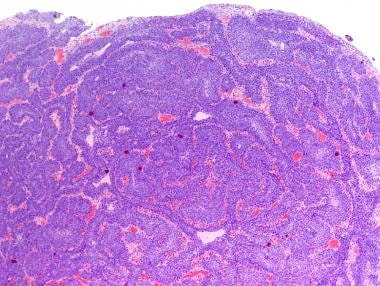 Urothelial inverted papilloma pathology outlines