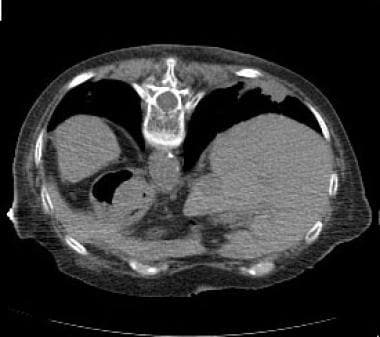 Thoracic CT performed in the prone position demons