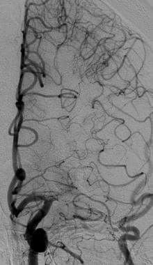 Middle cerebral artery occlusion with retrograde c