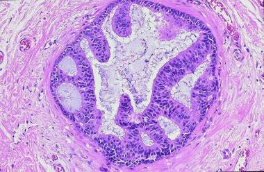 invasive ductal carcinoma histology