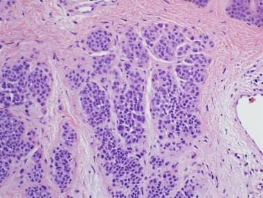 Histologic maturation of type A nevomelanoctyes to