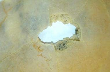 Keyhole wound of a skull's outer table. The bullet