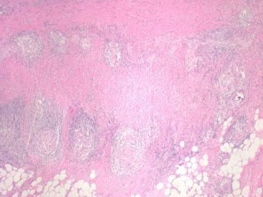 Prominent lymphoid aggregates and granuloma in the