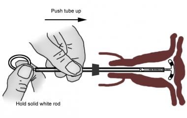 Mirena® IUD Safety Data