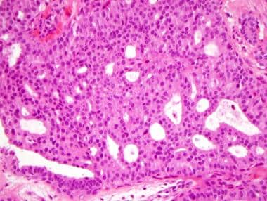 Intraductal papilloma ductal hyperplasia.