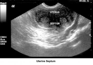 Infertility. Uterine septum. Image courtesy of Jai