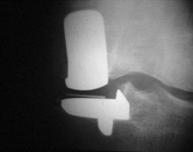 Radiograph demonstrating a medial unicompartmental