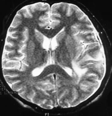 Pachymeningitis and cerebritis in a patient with b