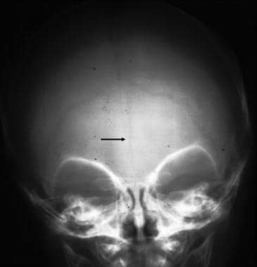 Frontal skull radiograph shows a persistent metopi