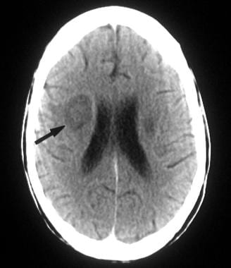 CNS Toxoplasmosis Imaging: Practice Essentials, Computed Tomography ...