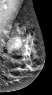 Mediolateral-oblique mammogram view also demonstra