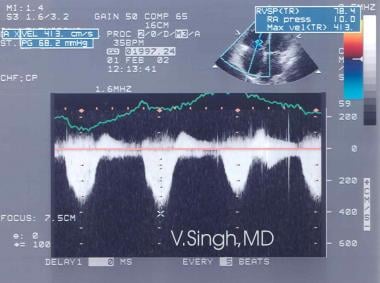Doppler echocardiographic assessment of a tricuspi