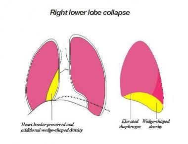 Image depicting a right lower lobe collapsing ante