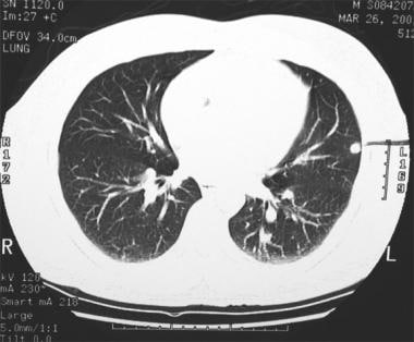 Thoracic histoplasmosis. Lung windows of the chest