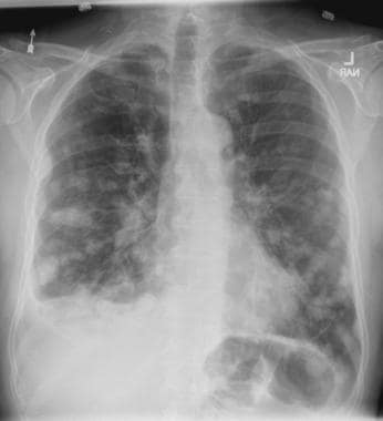 Chest radiograph of a 58-year-old man with maligna