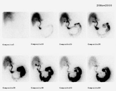 Cholelithiasis. Stasis of radioactivity in the duo