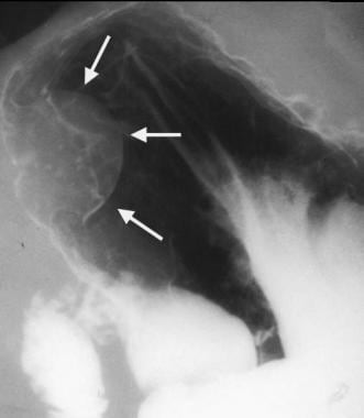 Gastrointestinal stromal tumor (GIST). Image obtai
