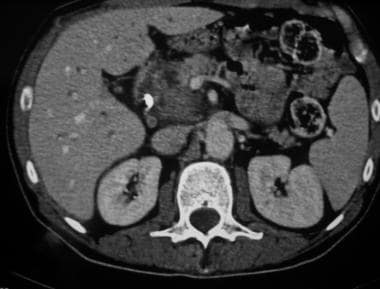 Scan from axial multisection CT in a patient with 