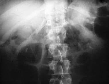 Plain abdominal radiograph in a 40-year-old man. T