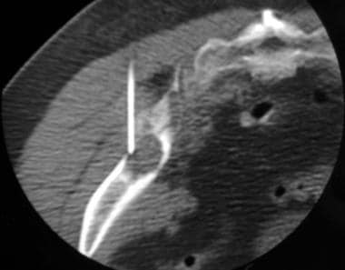 Computed tomography (CT)-guided biopsy was perform