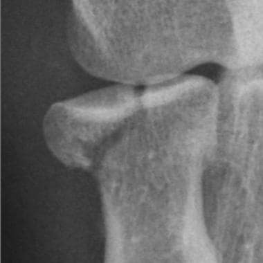 Elbow, fractures and dislocations. Radial head fra