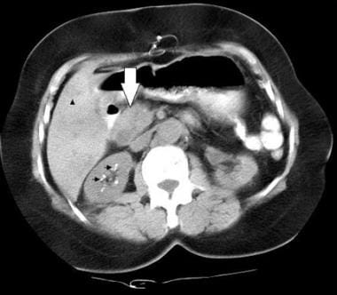 Computed tomography (CT) scan of the pancreas in a