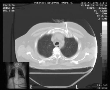 Computed tomography (CT)–guided biopsy for a lesio