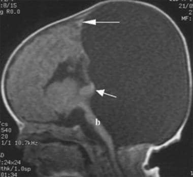 This sagittal T1-weighted MRI scan in an 11-day-ol