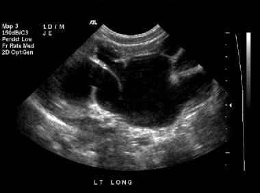 Renal sonogram (same patient as in the previous 2 