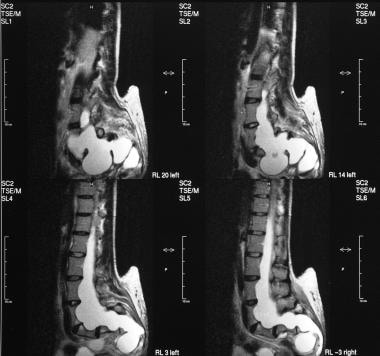T2-weighted sagittal MRIs of the sacrum show an an