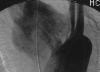 Aorta, trauma. Posteroanterior angiogram shows dis