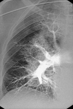 Pulmonary angiography. Digital subtraction pulmona