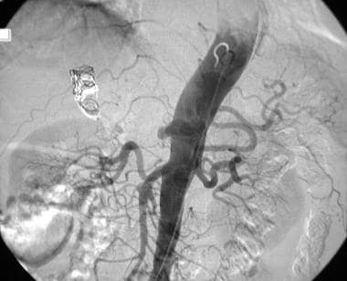 Vascular and solid organ trauma. Celiac angiogram 