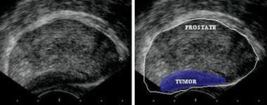 Transrectal sonogram of the prostate showing a hyp