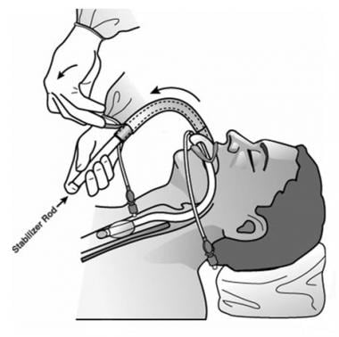 Removing the ILMA after intubation. 
