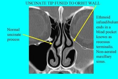 CT scan, nasal cavity. Congenital or true fusion o