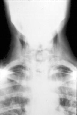 Pediatric Thoracic Trauma. Subcutaneous emphysema 