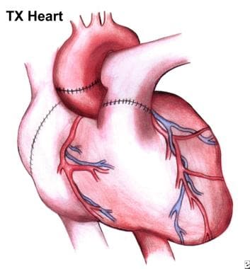 End-Stage Heart Disease and Indications for Heart Transplantation