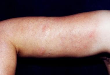 Acrodermatitis Chronica Atrophicans Clinical Presentation: History ...