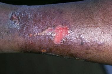 Diabetes Patient Develops Large Blisters, Macules on Lower Leg