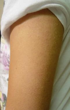 Keratosis pilaris bumps on arm of a white female t