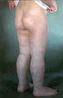 Klippel-Trenaunay syndrome in a young person. Note