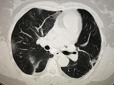 CT scan of a 60-year-old woman with proven SARS-co