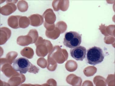 Pathology of Acute Myeloid Leukemia With Myelodysp