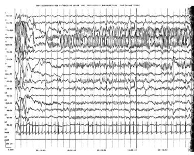 Focal status epilepticus. Electroencephalograph (E