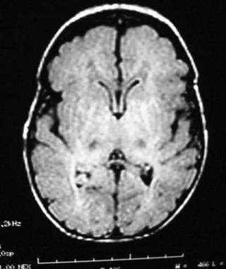 Magnetic resonance image (MRI) of a 9-day-old girl